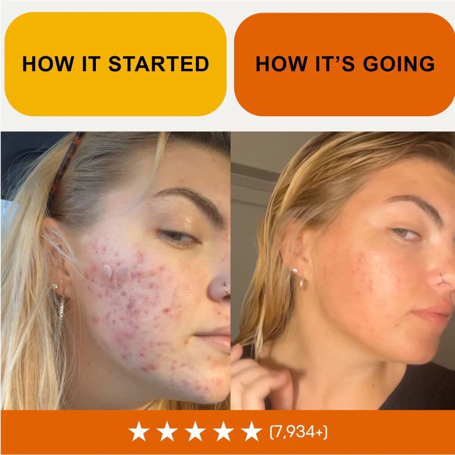 Norse Organics Redness & Breakout Support Ritual